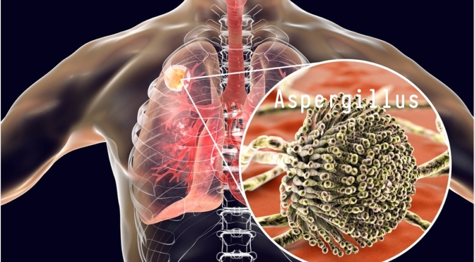 Fungal Infections In The Lungs:  Aspergillus