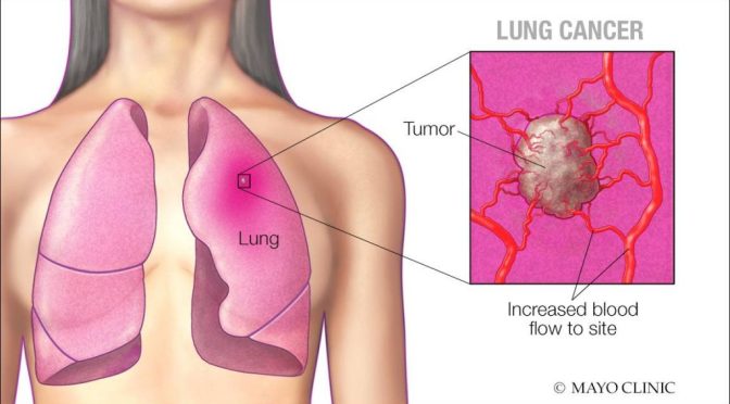 Lung Cancer: Advantages Of Low-Dose CT Scans