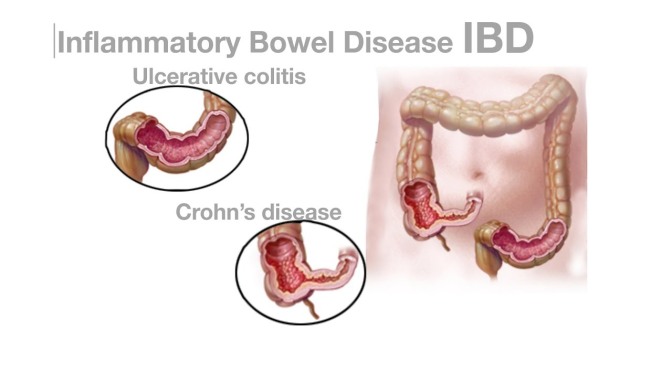 Disorders: Inflammatory Bowel Disease (Video)