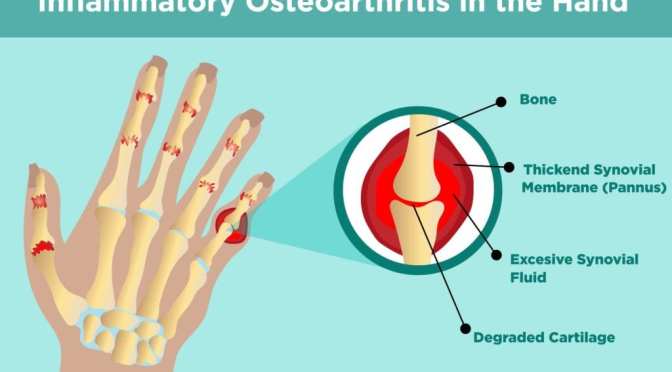 Dr. C’s Journal: Care Of Hand Osteoarthritis