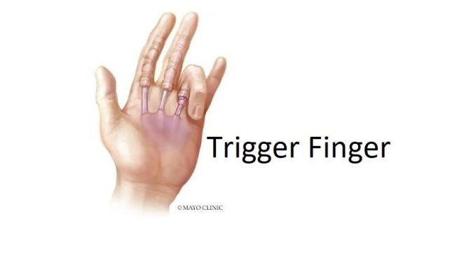 Hand Conditions: What Causes Trigger Finger?