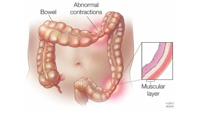 Coping With Irritable Bowel Syndrome (IBS)